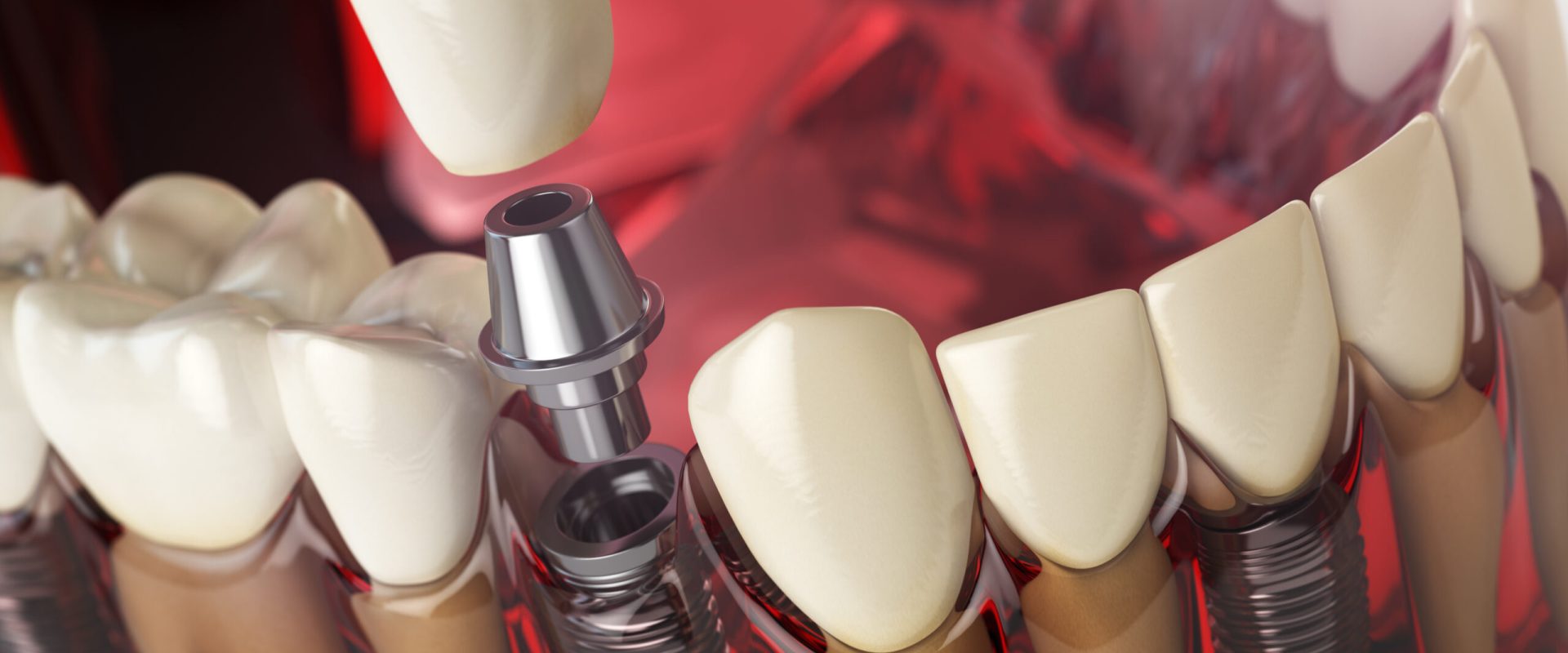 Tooth implant in the model human teeth, gums and denturas. Dental medicine stomatology concept. 3d illustration